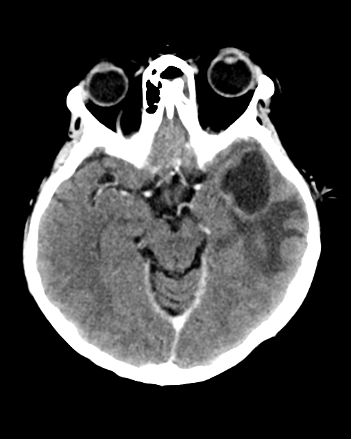 Nasopharyngeal carcinoma with cerebral abscess (Radiopaedia 43018-46275 Axial C+ delayed 21).png