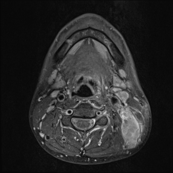 Nasopharyngeal carcinoma with skull base invasion (Radiopaedia 53415-59485 Axial T1 C+ fat sat 49).jpg