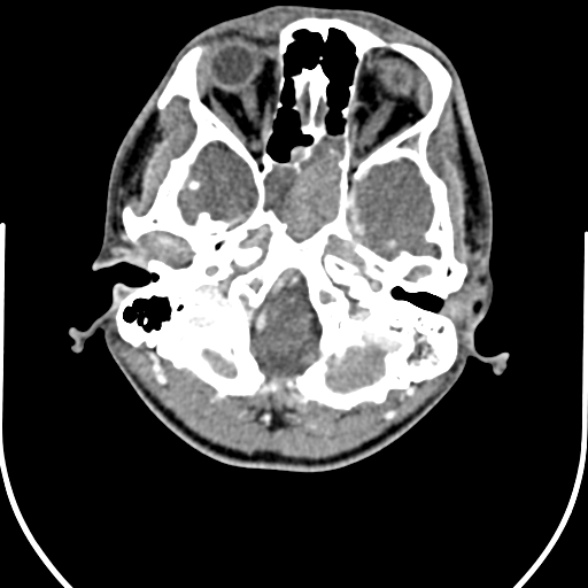Nasopharyngeal carcinoma with skull base invasion (Radiopaedia 53415-59705 A 19).jpg