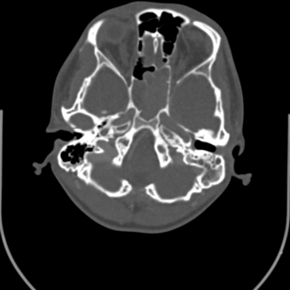 File:Nasopharyngeal carcinoma with skull base invasion (Radiopaedia 53415-59705 Axial bone window 17).jpg