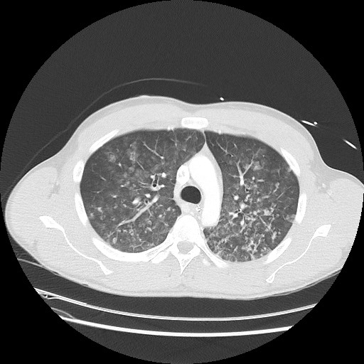 Near-drowning pulmonary edema (Radiopaedia 59457-66814 Axial lung window 19).jpg
