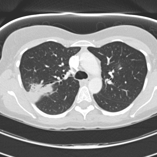 Necrobiotic pulmonary nodules - Crohn disease (Radiopaedia 20723-20631 Axial lung window 48).jpg