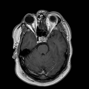 File:Neuro-Behcet's disease (Radiopaedia 21557-21506 Axial T1 C+ 10).jpg