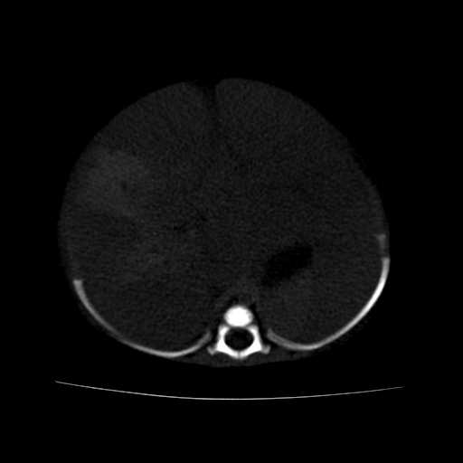 File:Neuroblastoma (Radiopaedia 20876-20799 Axial bone window 7).jpg