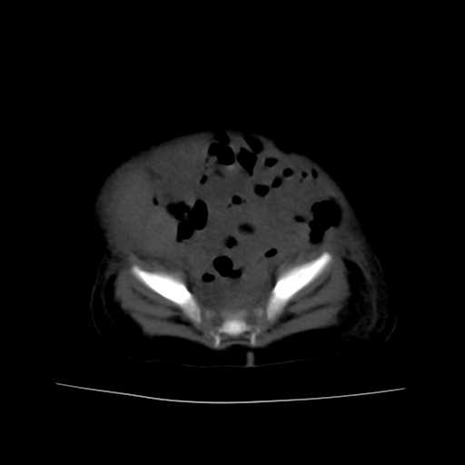 File:Neuroblastoma (Radiopaedia 20876-20799 Axial non-contrast 21).jpg