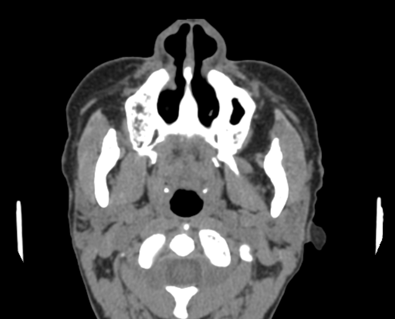 Neurofibromatosis type 1- orbital manifestations (Radiopaedia 49391-54511 Axial non-contrast 13).jpg