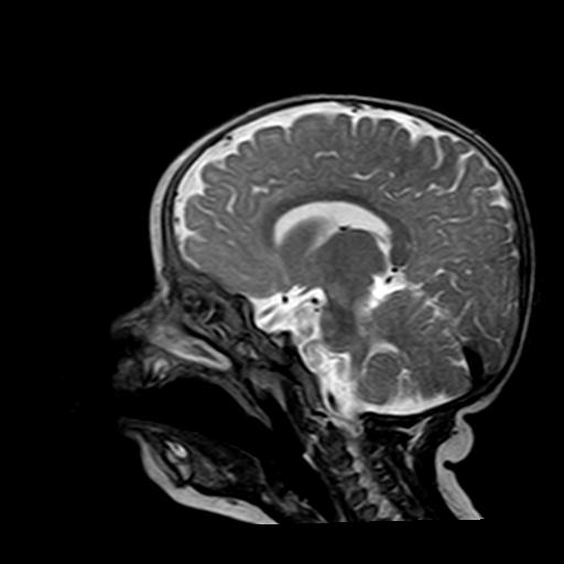 File:Neurofibromatosis type 1 (Radiopaedia 30089-30671 Sagittal T2 7).jpg