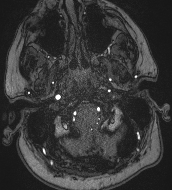 Neurofibromatosis type 1 - head and neck - CNS manifestations (Radiopaedia 49910-55188 Axial MRA 1).png