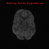 File:Neurofibromatosis type 1 with optic nerve glioma (Radiopaedia 16288-15965 Axial DWI 61).jpg