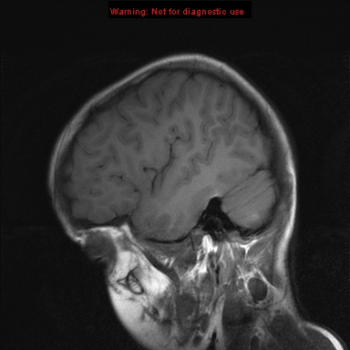File:Neurofibromatosis type 1 with optic nerve glioma (Radiopaedia 16288-15965 Sagittal T1 5).jpg