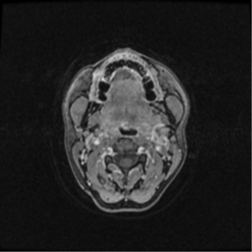 Neurofibromatosis type 2 (Radiopaedia 45229-49244 Axial T1 C+ 2).png