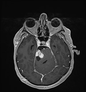 Neurofibromatosis type 2 (Radiopaedia 79097-92049 Axial T1 C+ 73).jpg