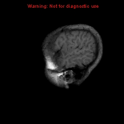 File:Neurofibromatosis type 2 (Radiopaedia 8953-9730 Sagittal T1 2).jpg