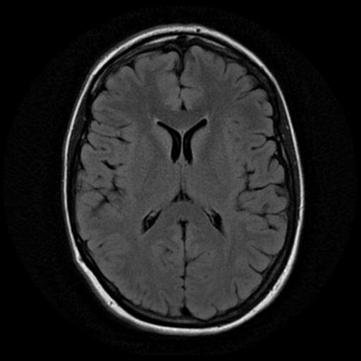 File:Neurofibromatosis type 2 - bilateral acoustic neuromata (Radiopaedia 40060-42566 Axial FLAIR 12).png