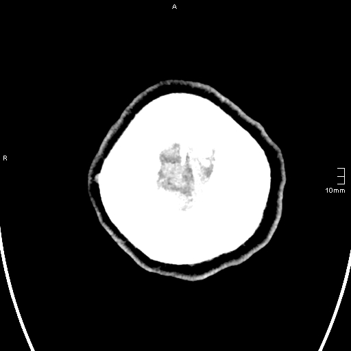 File:Neurotoxoplasmosis - concentric target sign (Radiopaedia 70644-80783 Axial non-contrast 40).jpg