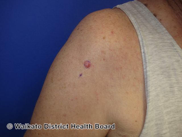 File:Nodular basal cell carcinoma, arm (DermNet NZ nbcc-arm-19-wdhb).jpg