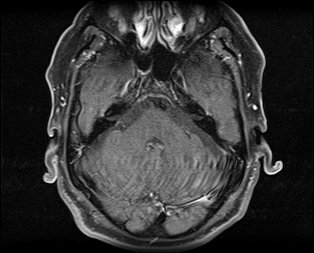 File:Non-Hodgkin lymphoma - parotid gland (Radiopaedia 71531-81890 Axial T1 C+ fat sat 23).jpg