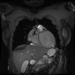 File:Non-compaction of the left ventricle (Radiopaedia 38868-41062 Coronal SSFP 2D FS 11).jpg
