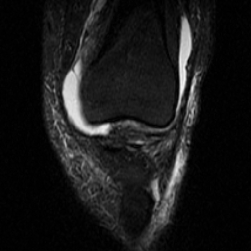 File:Non-displaced patella fracture (Radiopaedia 15932-15582 Coronal STIR 8).jpg