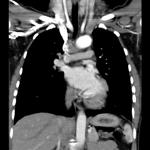 File:Non-small cell lung cancer with miliary metastases (Radiopaedia 23995-24193 B 9).jpg