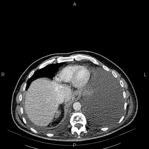 File:Non Hodgkin lymphoma in a patient with ankylosing spondylitis (Radiopaedia 84323-99621 B 27).jpg