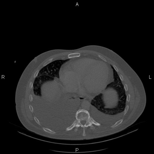 Non Hodgkin lymphoma in a patient with ankylosing spondylitis (Radiopaedia 84323-99624 Axial bone window 21).jpg