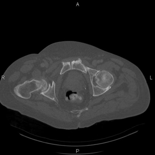 Non Hodgkin lymphoma in a patient with ankylosing spondylitis (Radiopaedia 84323-99624 Axial bone window 63).jpg