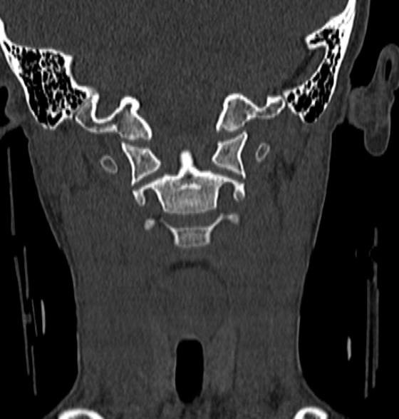 File:Normal CT cervical spine - 12-year-old (Radiopaedia 55352-61775 Coronal bone window 70).jpg
