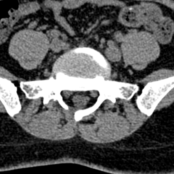 Normal CT lumbar spine (Radiopaedia 53981-60118 Axial non-contrast 87).jpg