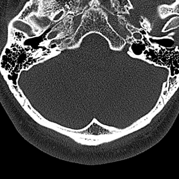 Normal CT of the cervical spine (Radiopaedia 53322-59305 Axial bone window 14).jpg