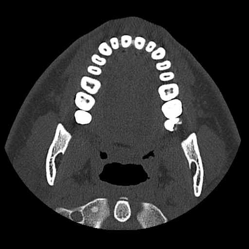 Normal CT paranasal sinuses (Radiopaedia 42286-45390 Axial bone window 110).jpg