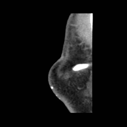 Normal CT paranasal sinuses (Radiopaedia 42286-45390 F 140).jpg