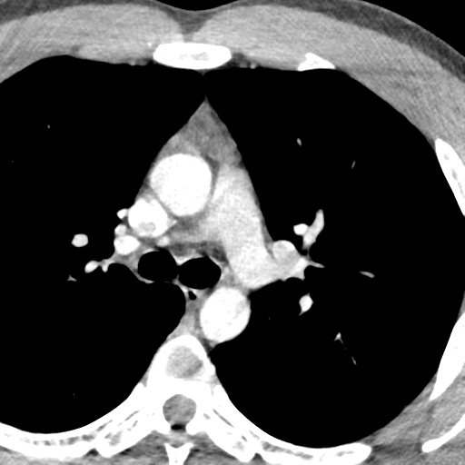 File:Normal CT pulmonary veins (pre RF ablation) (Radiopaedia 41748-44702 A 47).png