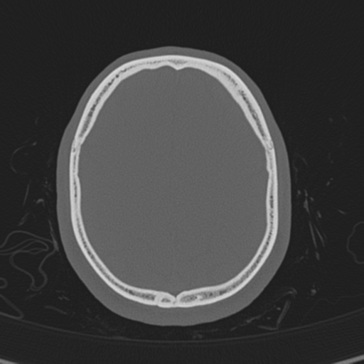 Normal CT skull (Radiopaedia 40798-43459 A 124).png