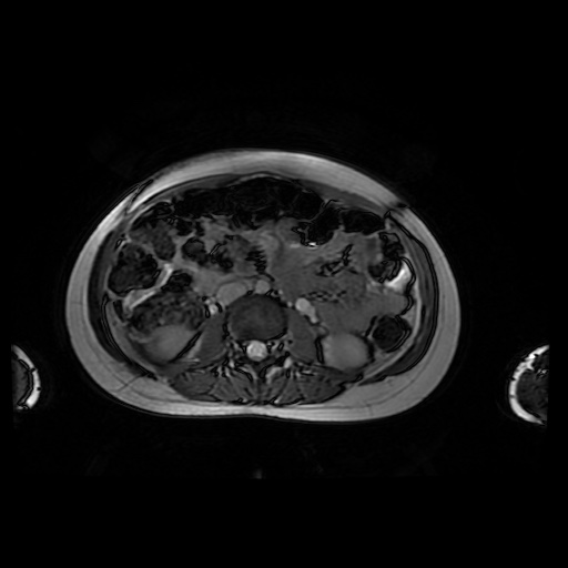File:Normal MRI abdomen in pregnancy (Radiopaedia 88001-104541 Axial Gradient Echo 26).jpg