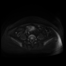 Normal MRI abdomen in pregnancy (Radiopaedia 88005-104548 Axial DWI 103).jpg