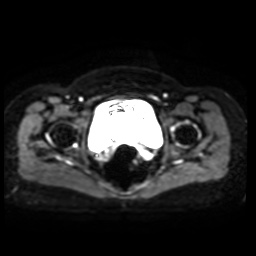 Normal MRI abdomen in pregnancy (Radiopaedia 88005-104548 Axial DWI 12).jpg