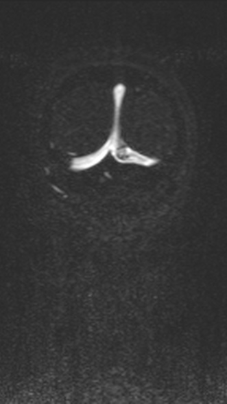 Normal MRI brain with MRV- teenager (Radiopaedia 49425-54553 Coronal MRV 212).jpg