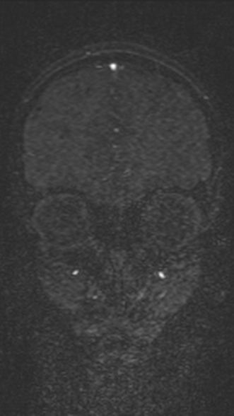 Normal MRI brain with MRV- teenager (Radiopaedia 49425-54553 Coronal MRV 66).jpg