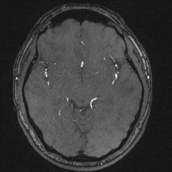 Normal brain MRI including MRA (Radiopaedia 48748-53763 Axial MRA 95).jpg