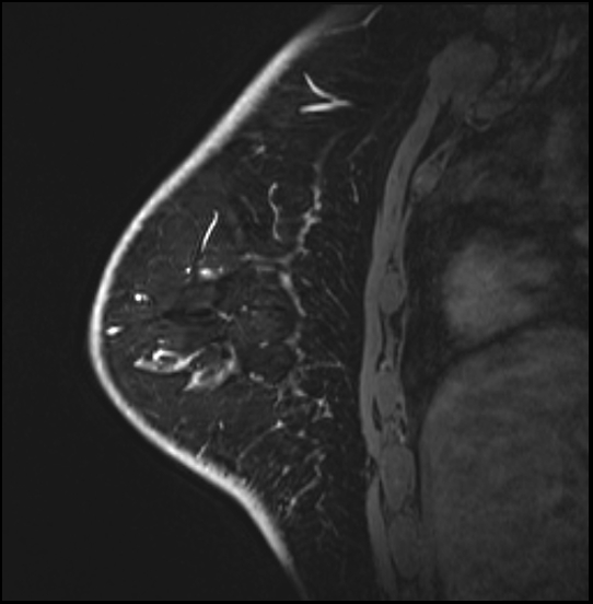 Normal breast MRI - dense breasts (Radiopaedia 80454-93850 I 140).jpg