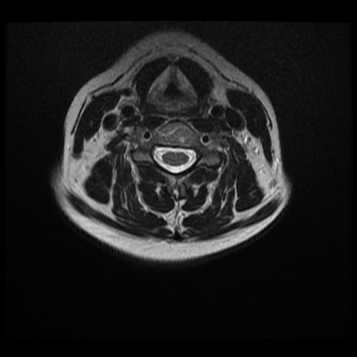 File:Normal cervical and thoracic spine MRI (Radiopaedia 35630-37156 Axial T2 18).png