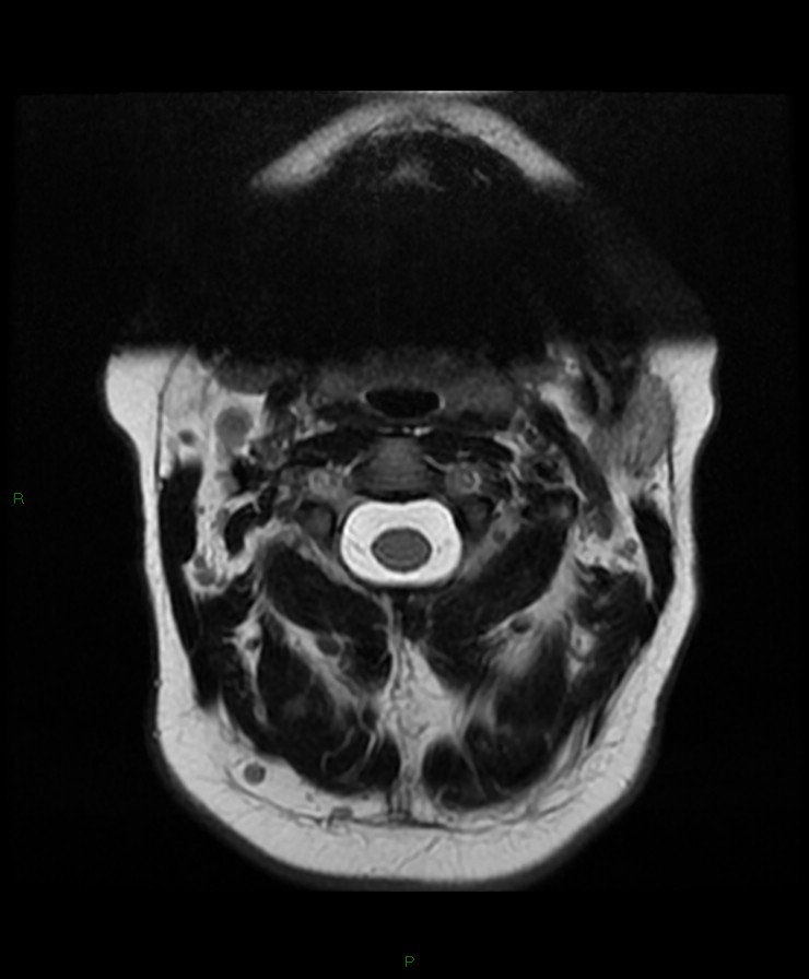 Normal cervical spine MRI (Radiopaedia 80146-93454 Axial T2 5).jpg