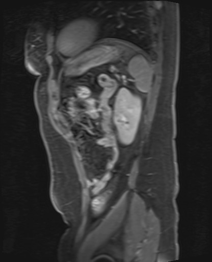 File:Normal hepatobiliary phase liver MRI (Radiopaedia 58968-66230 C 62).jpg