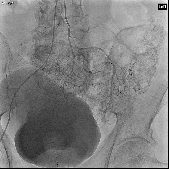 File:Normal inferior mesenteric artery angiogram (Radiopaedia 80639).jpg