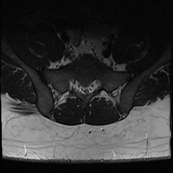 File:Normal lumbar spine MRI (Radiopaedia 47857-52609 Axial T2 32).jpg