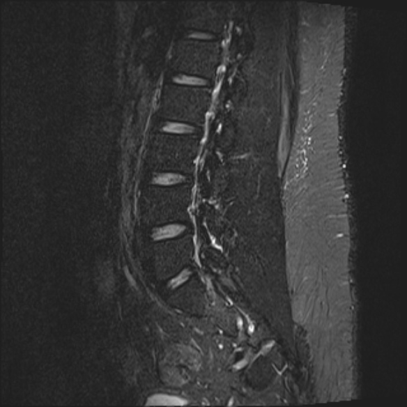 File:Normal lumbar spine MRI (Radiopaedia 47857-52609 Sagittal STIR 14).jpg
