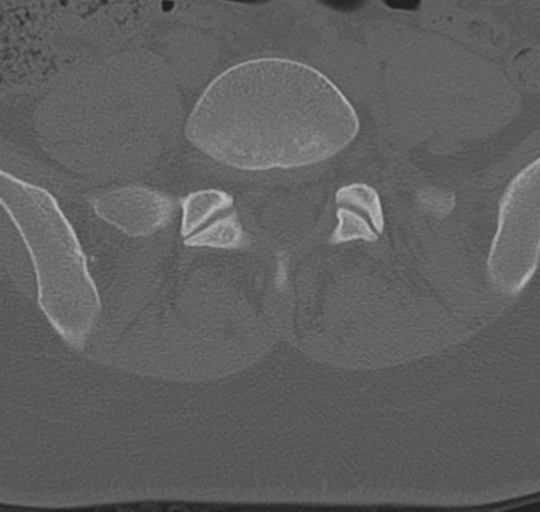 File:Normal lumbosacral CT (Radiopaedia 37923-39867 Axial bone window 77).png