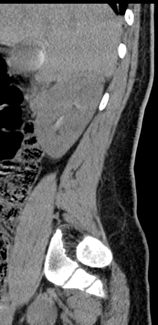 Normal lumbosacral CT (Radiopaedia 37923-39867 E 92).png
