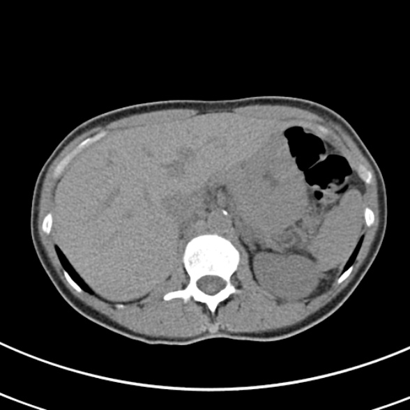 File:Normal multiphase CT liver (Radiopaedia 38026-39996 Axial non-contrast 17).jpg